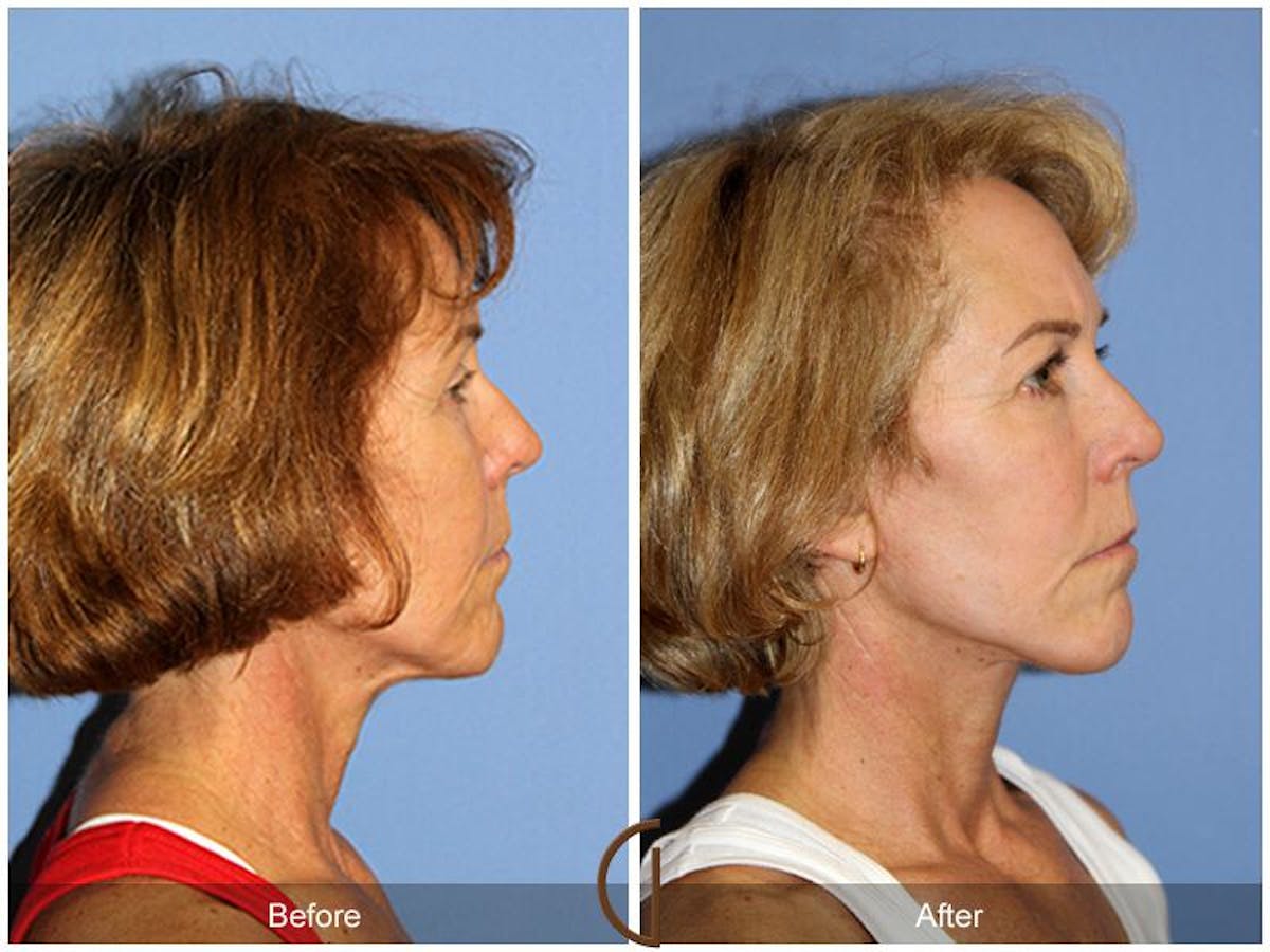 Facelift 60s Before & After Gallery - Patient 171018 - Image 3
