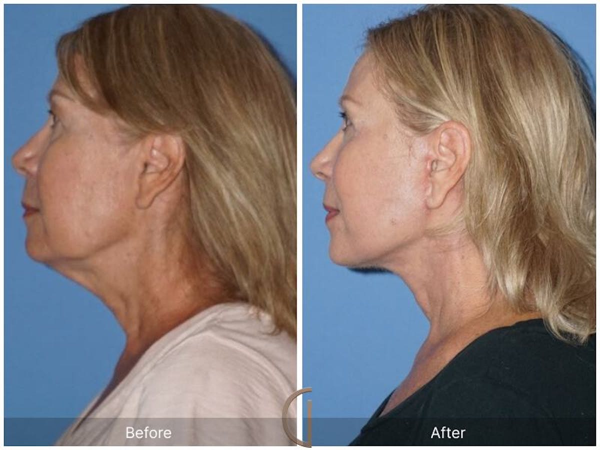 Facelift 60s Before & After Gallery - Patient 882691 - Image 1