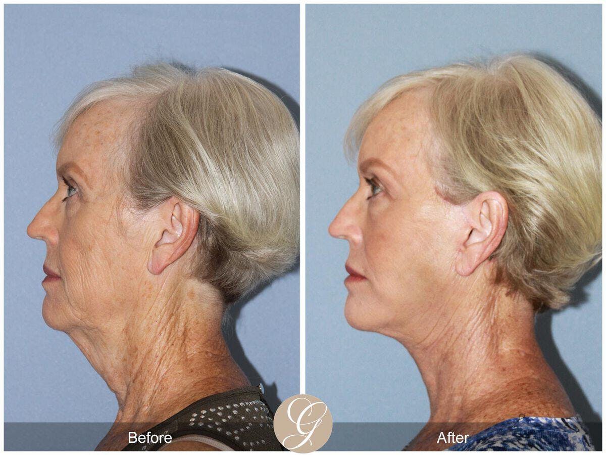 Facelift 60s Before & After Gallery - Patient 398484 - Image 1