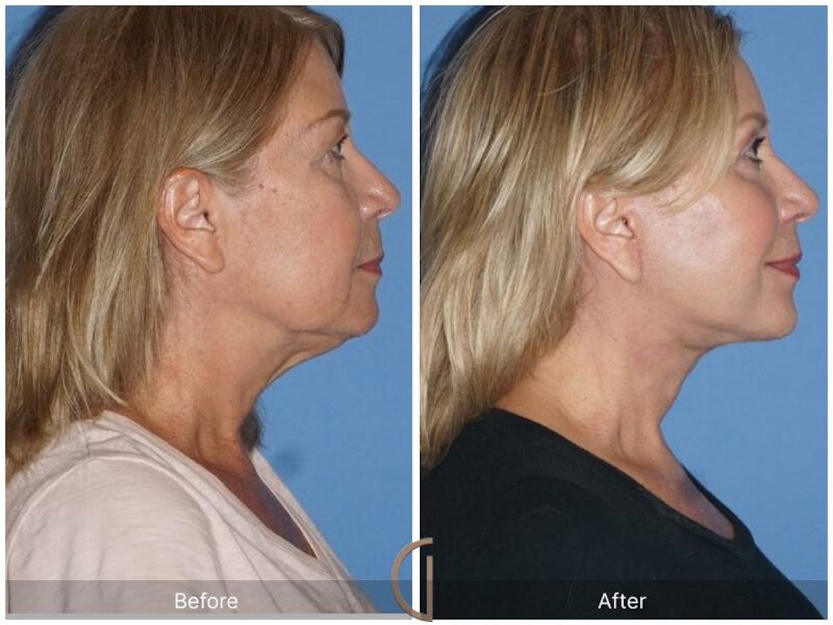 Facelift 60s Before & After Gallery - Patient 882691 - Image 3