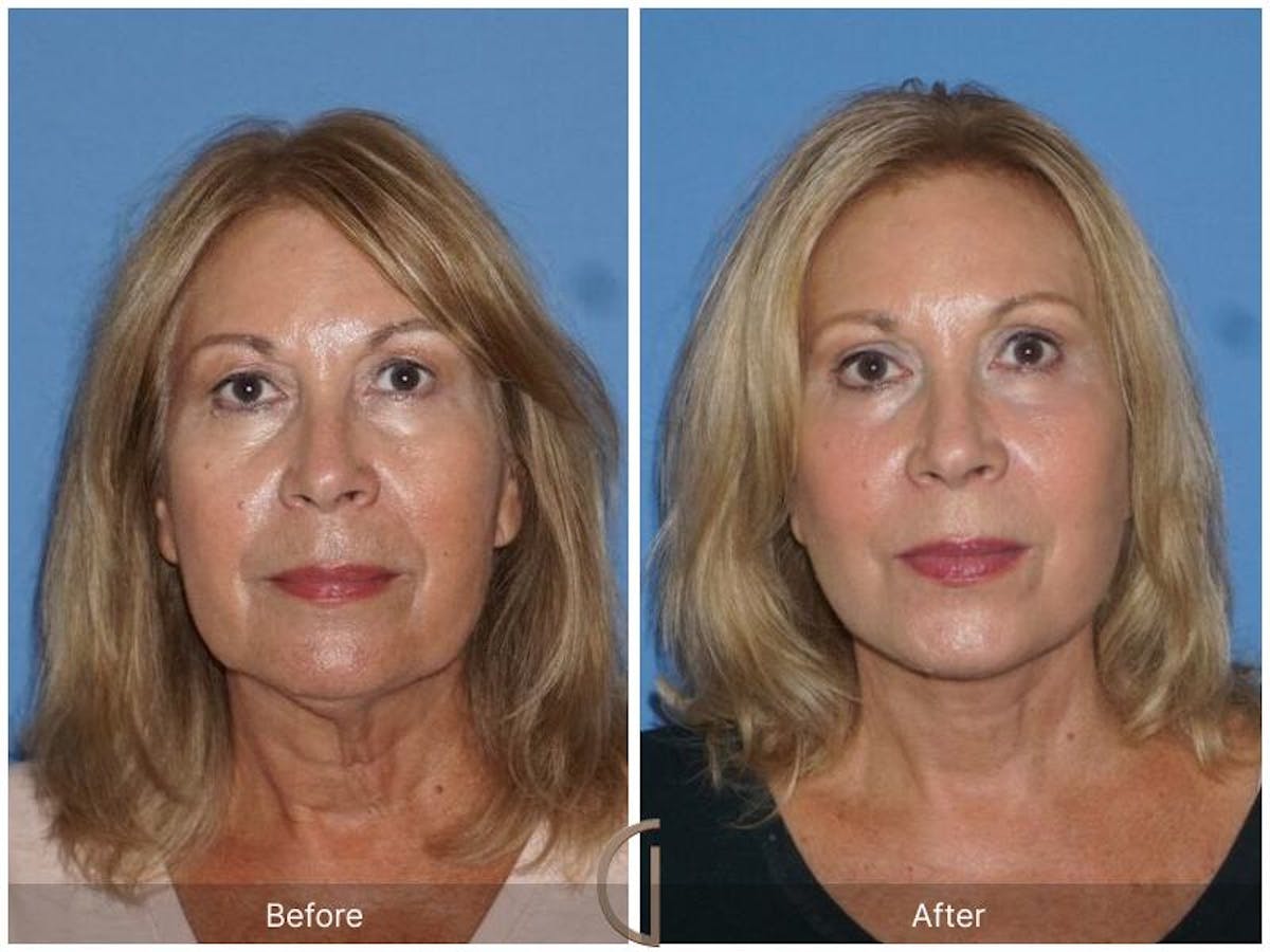 Facelift 60s Before & After Gallery - Patient 882691 - Image 2