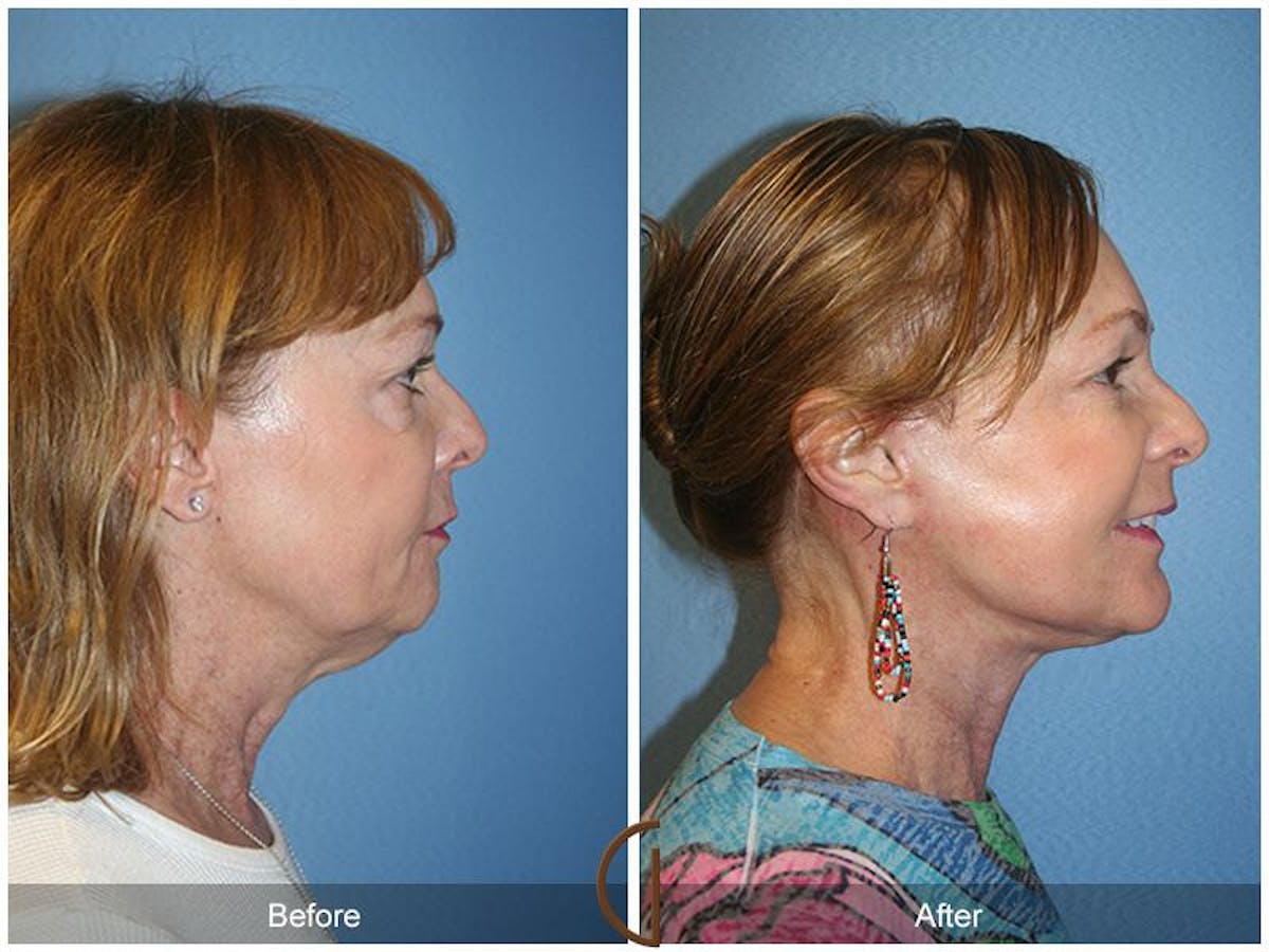 Facelift 60s Before & After Gallery - Patient 722893 - Image 3