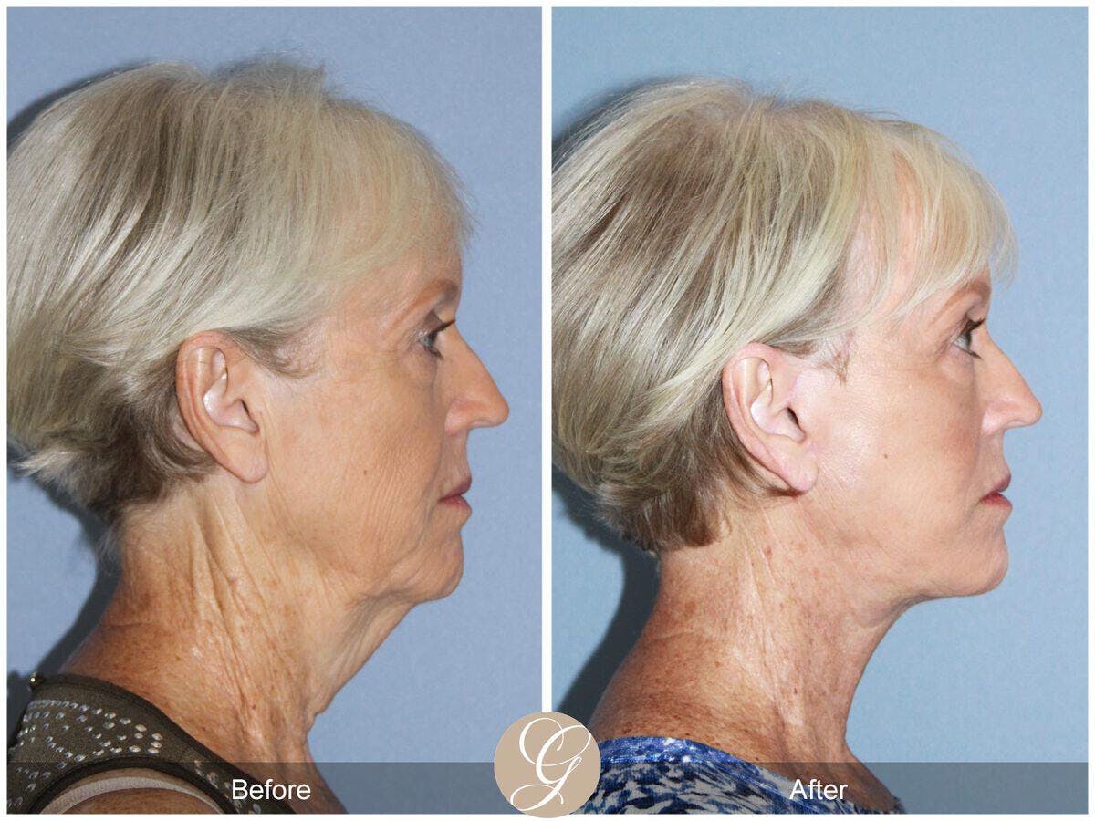 Facelift 60s Before & After Gallery - Patient 398484 - Image 3