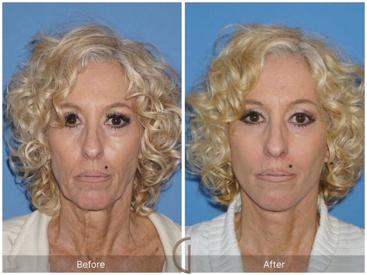 Facelift 60s Before & After Gallery - Patient 260953 - Image 2