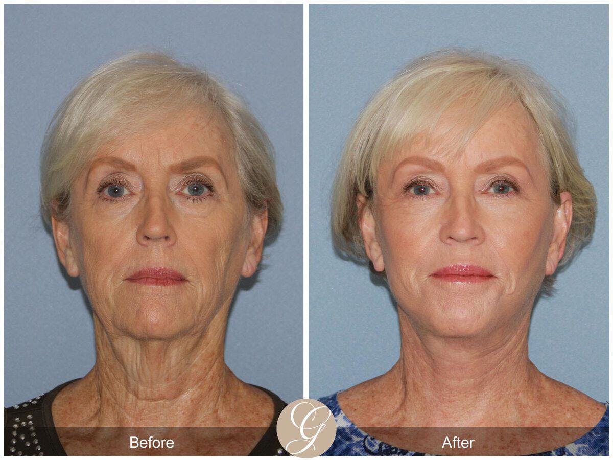 Facelift 60s Before & After Gallery - Patient 398484 - Image 2