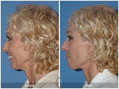 Facelift 60s Before & After Gallery - Patient 260953 - Image 1