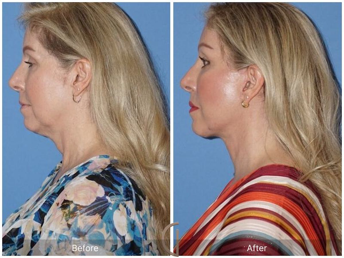 Facelift 50s Before & After Gallery - Patient 346356 - Image 1