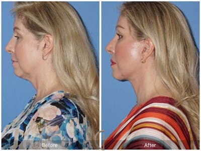 Facelift 50s Before & After Gallery - Patient 346356 - Image 1