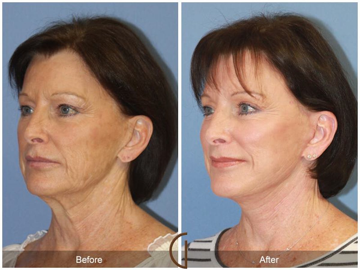Facelift 60s Before & After Gallery - Patient 599296 - Image 3