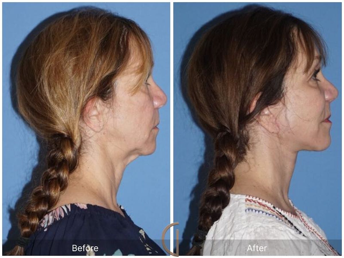Facelift 50s Before & After Gallery - Patient 312979 - Image 3
