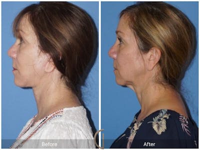 Facelift 50s Before & After Gallery - Patient 312979 - Image 1