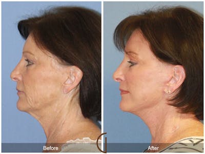 Facelift 60s Before & After Gallery - Patient 599296 - Image 1