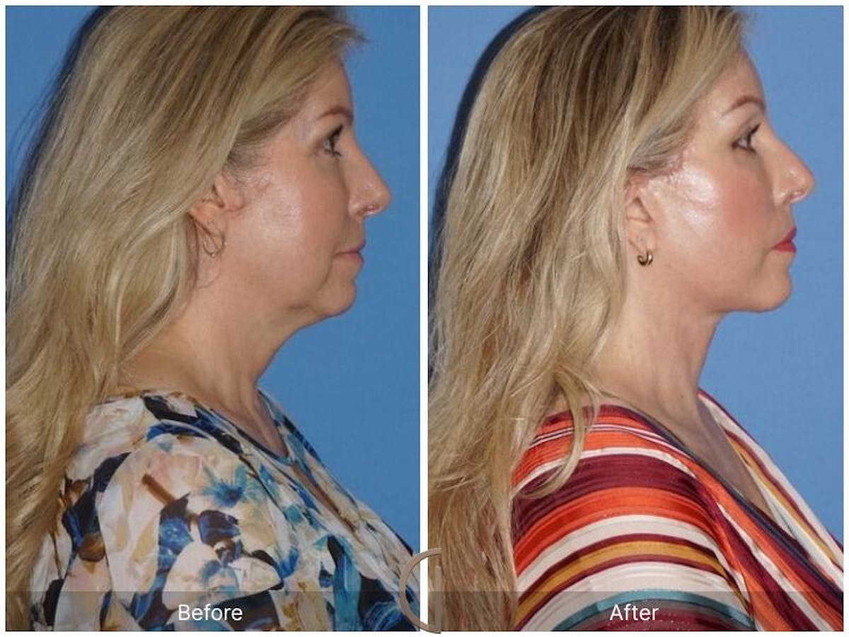 Facelift 50s Before & After Gallery - Patient 346356 - Image 3
