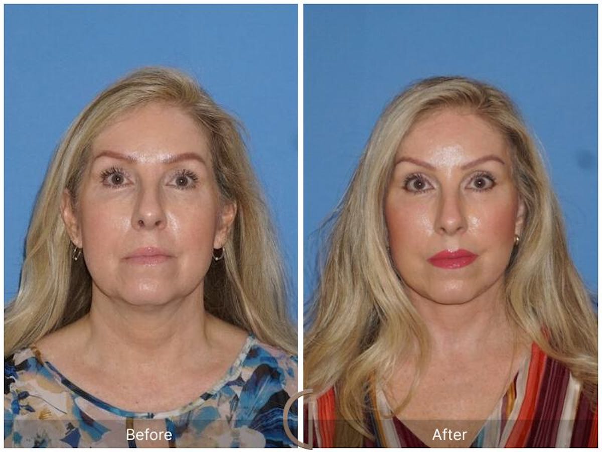 Facelift 50s Before & After Gallery - Patient 346356 - Image 2