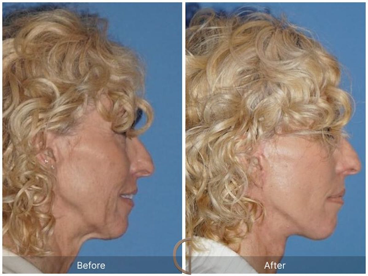 Facelift 60s Before & After Gallery - Patient 260953 - Image 3