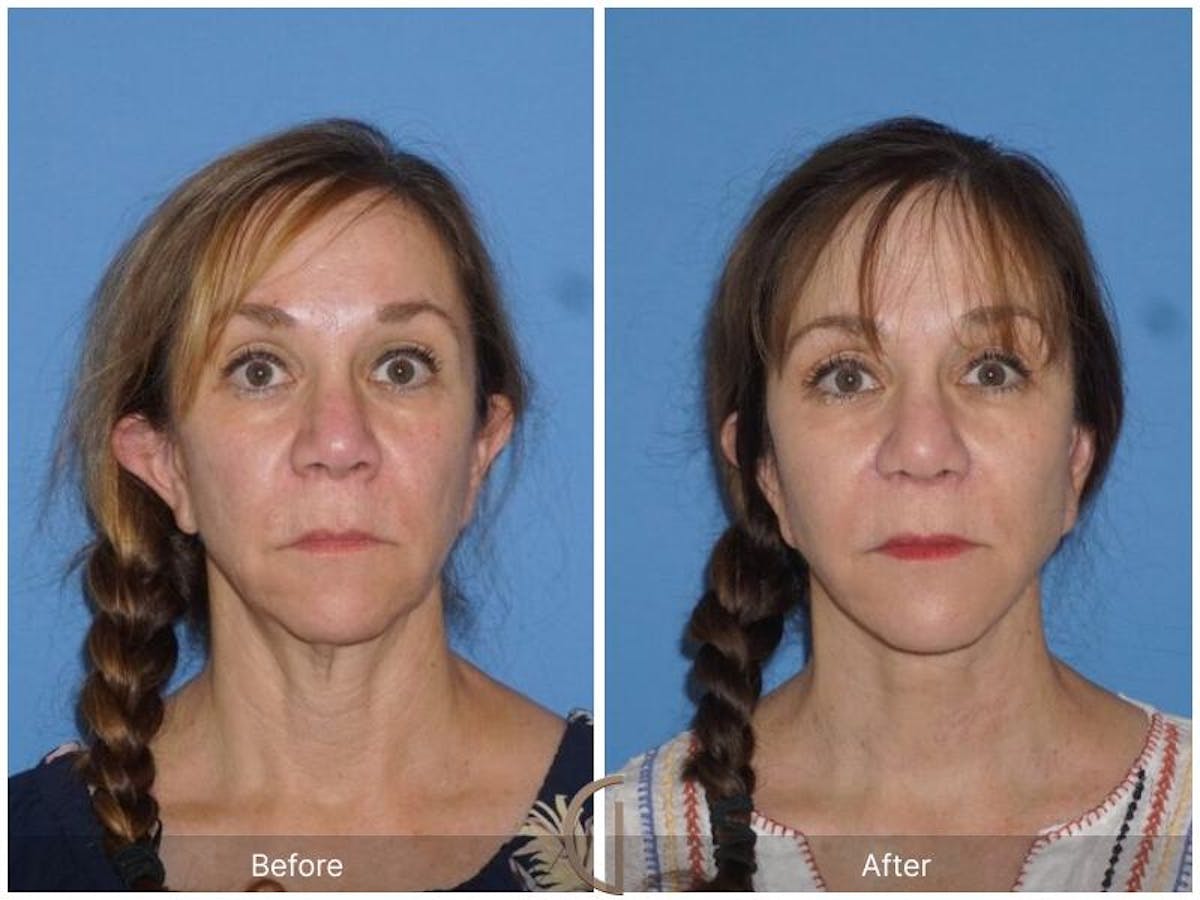 Facelift 50s Before & After Gallery - Patient 312979 - Image 2