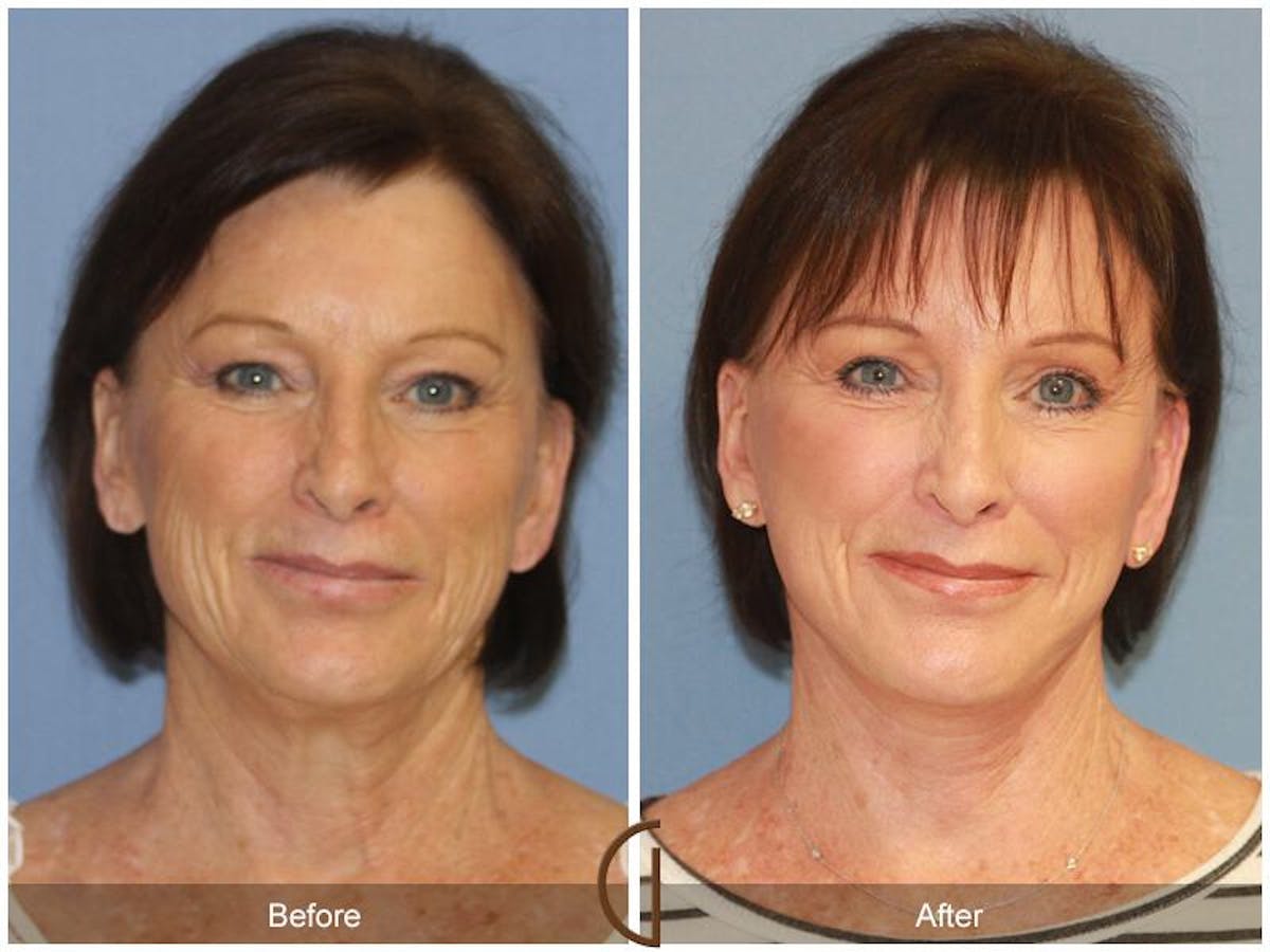 Facelift 60s Before & After Gallery - Patient 599296 - Image 2
