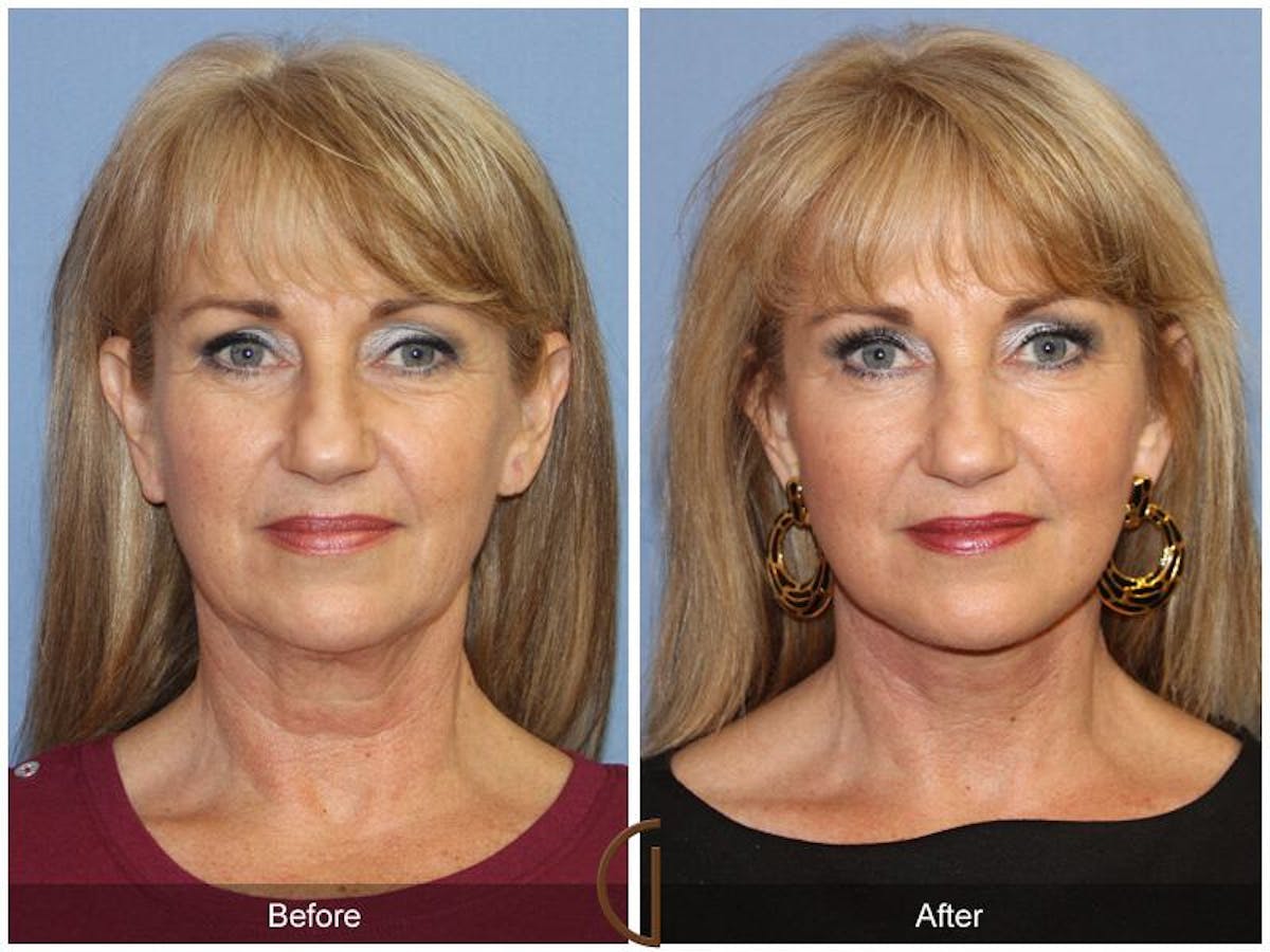 Facelift 50s Before & After Gallery - Patient 167568 - Image 2