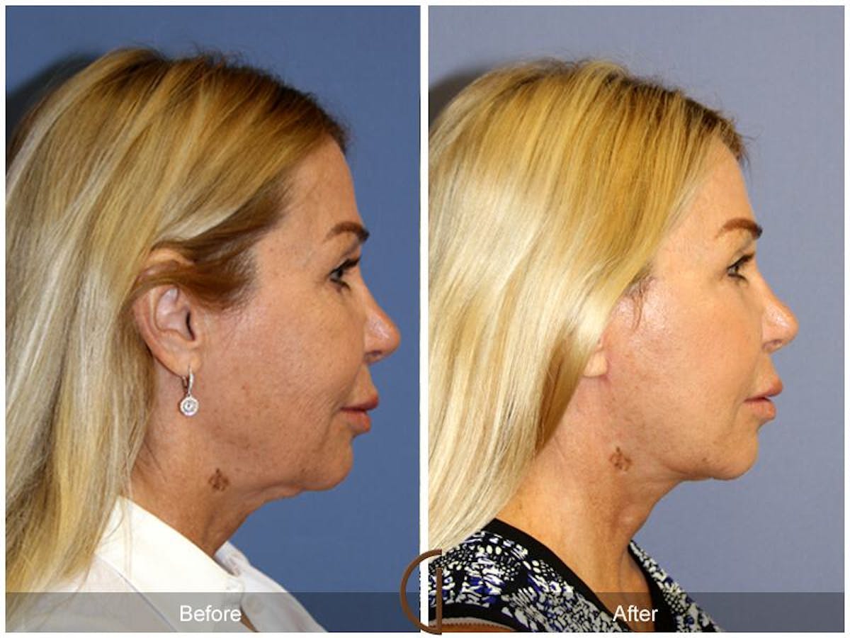 Facelift 50s Before & After Gallery - Patient 299361 - Image 3