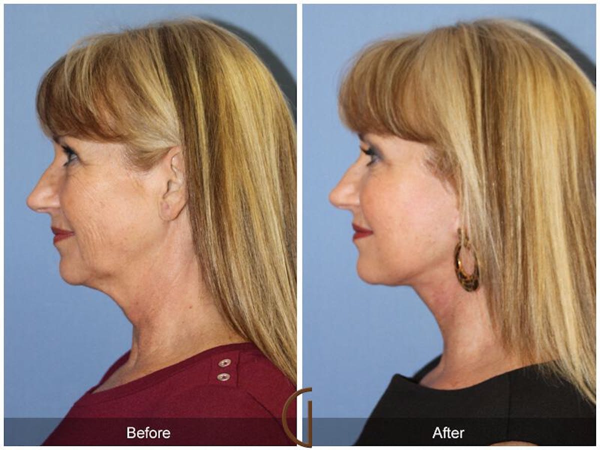 Facelift 50s Before & After Gallery - Patient 167568 - Image 1