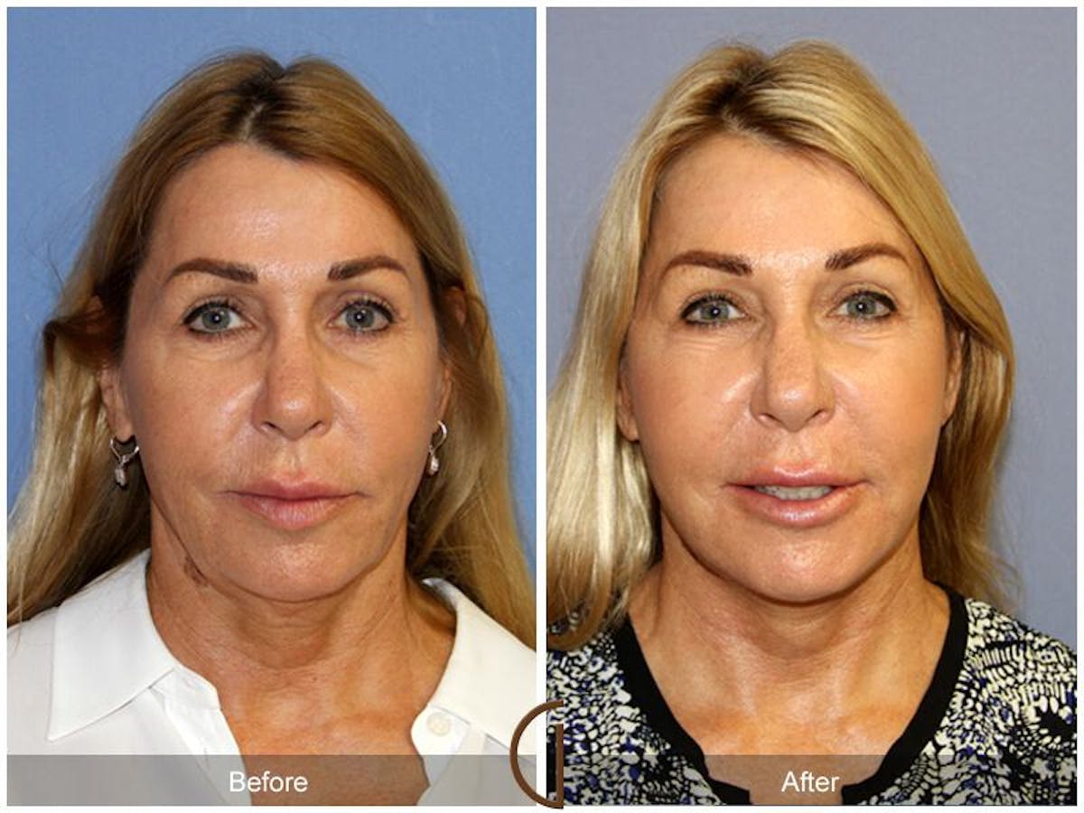 Facelift 50s Before & After Gallery - Patient 299361 - Image 2
