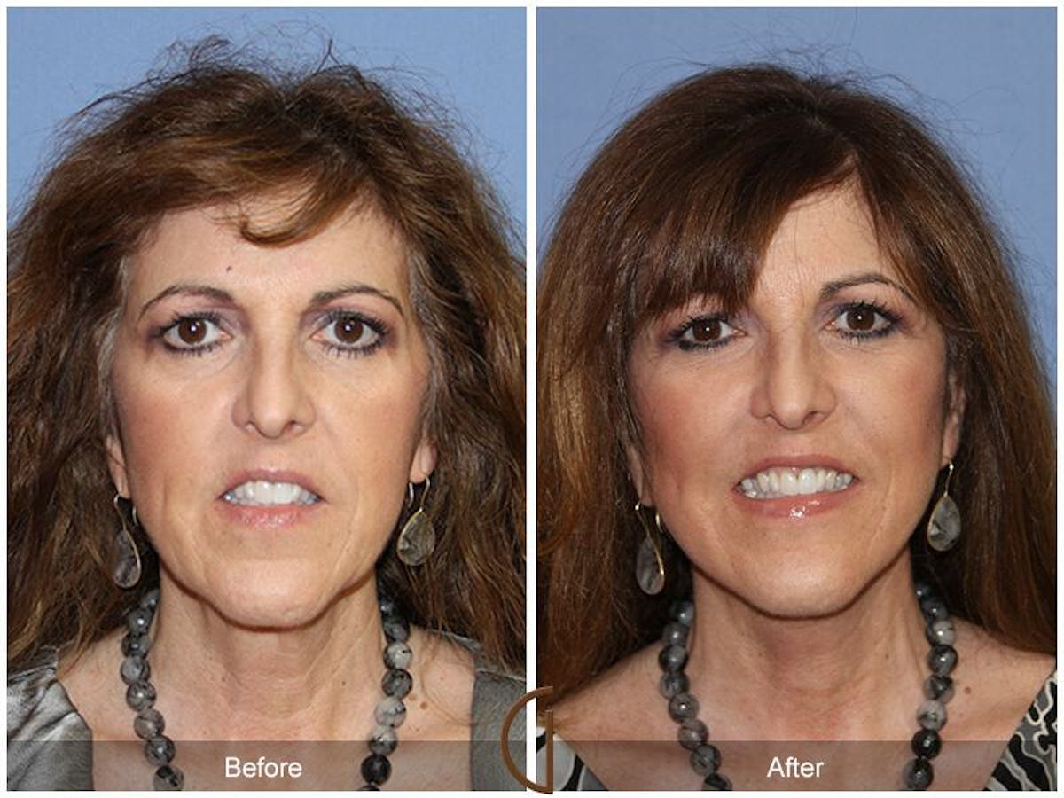 Facelift 50s Before & After Gallery - Patient 298893 - Image 2