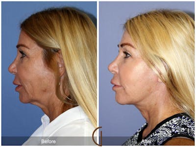 Facelift 50s Before & After Gallery - Patient 299361 - Image 1