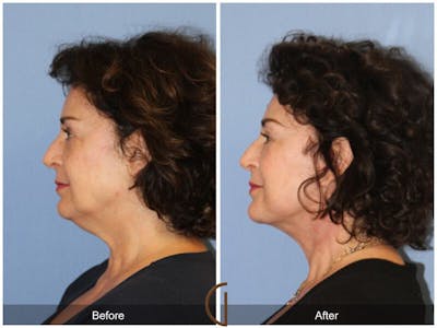 Facelift 50s Before & After Gallery - Patient 714973 - Image 1