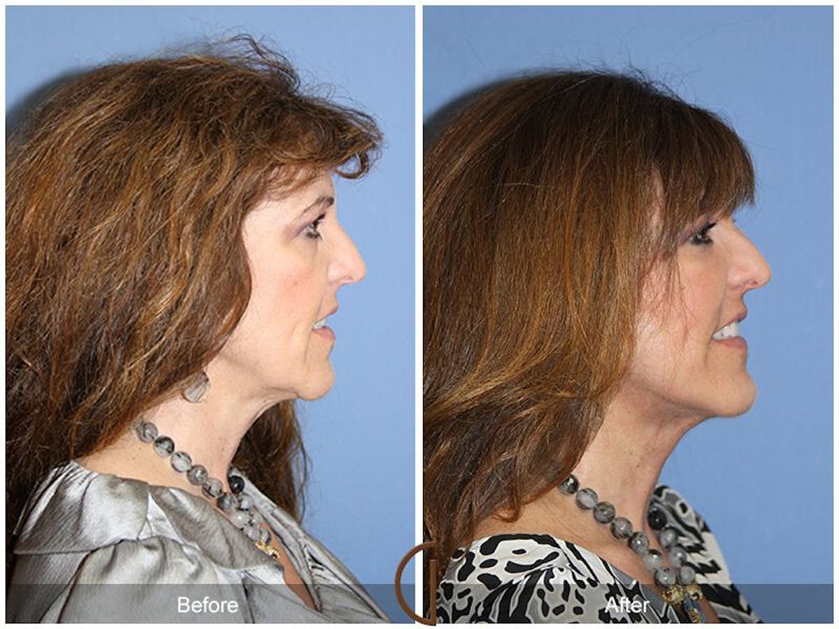 Facelift 50s Before & After Gallery - Patient 298893 - Image 3