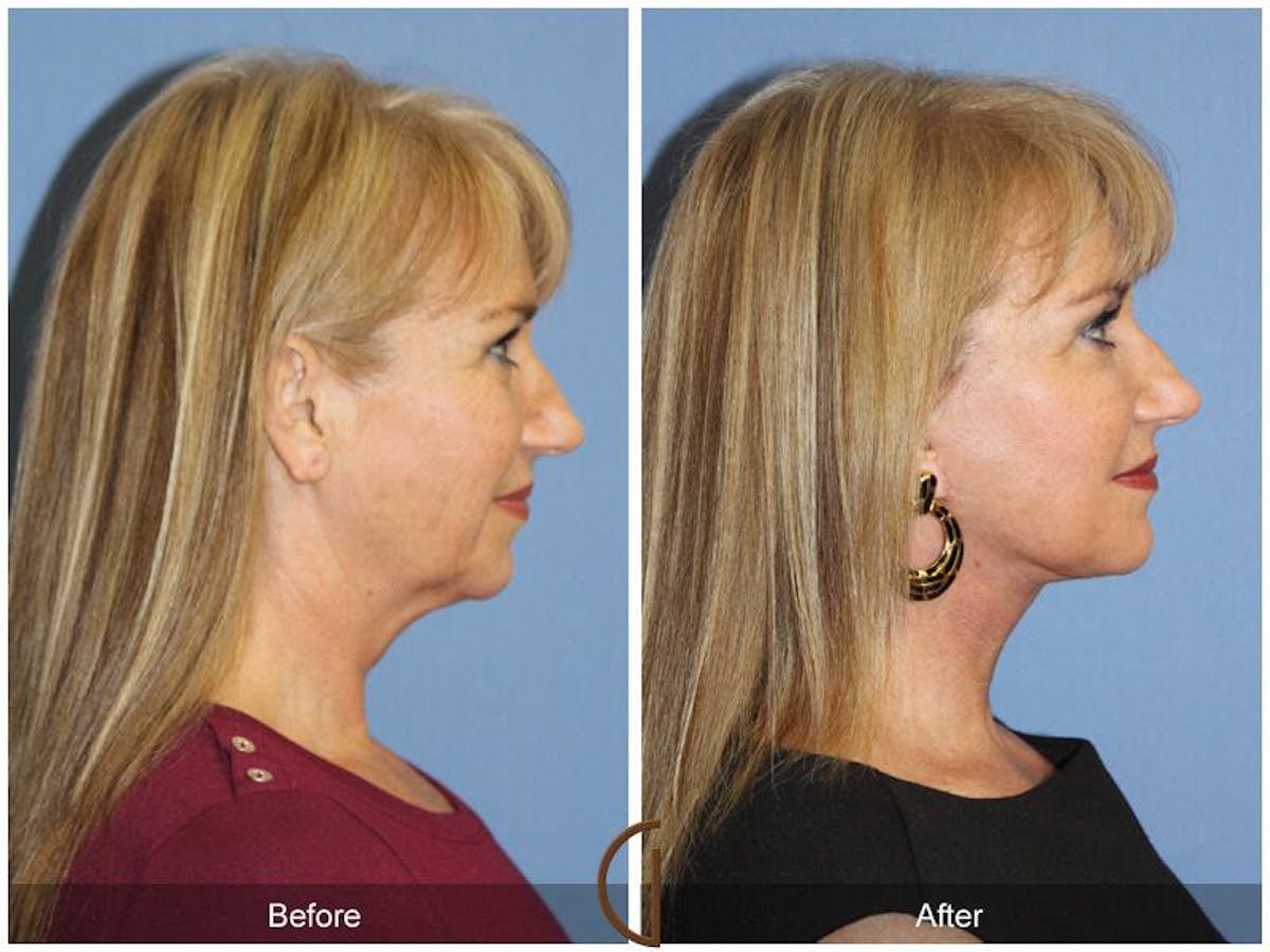 Facelift 50s Before & After Gallery - Patient 167568 - Image 3