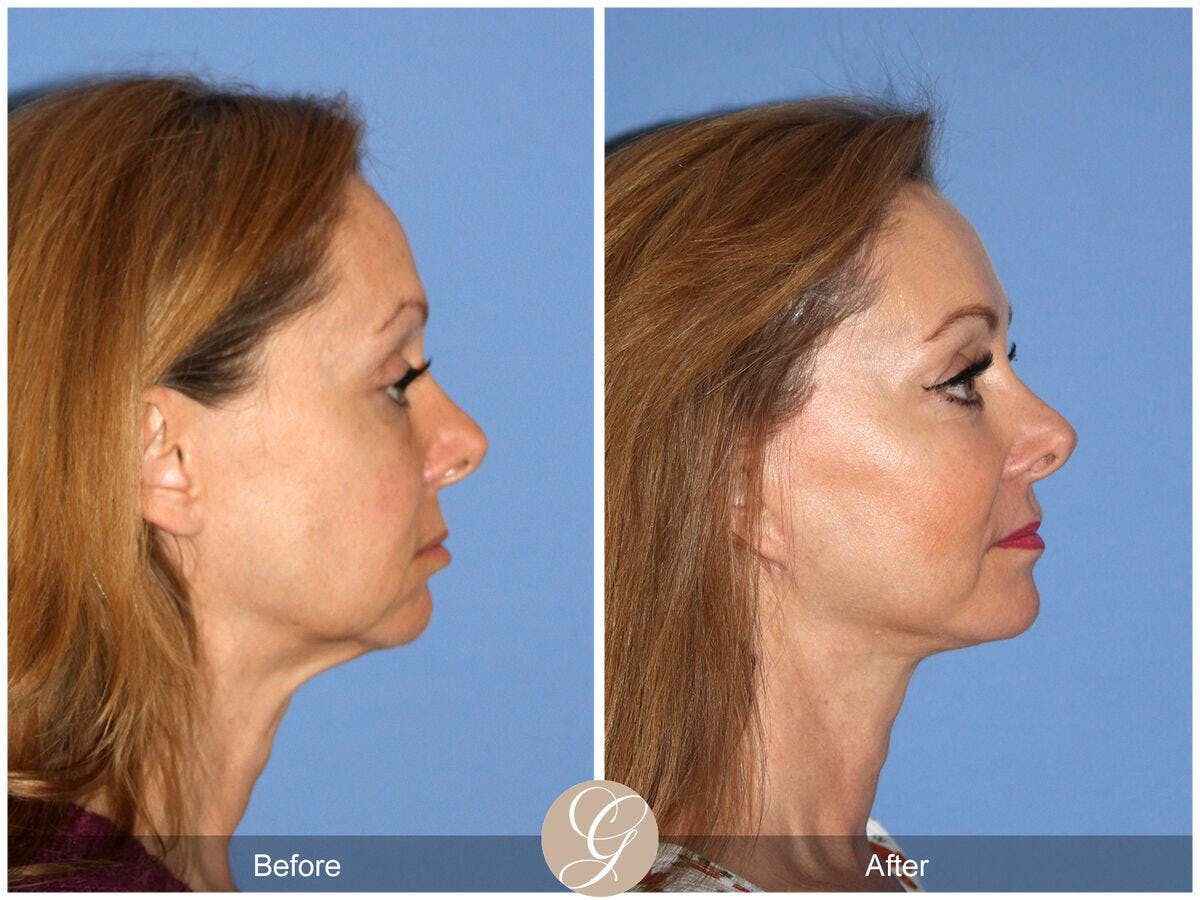 Facelift 50s Before & After Gallery - Patient 978693 - Image 3