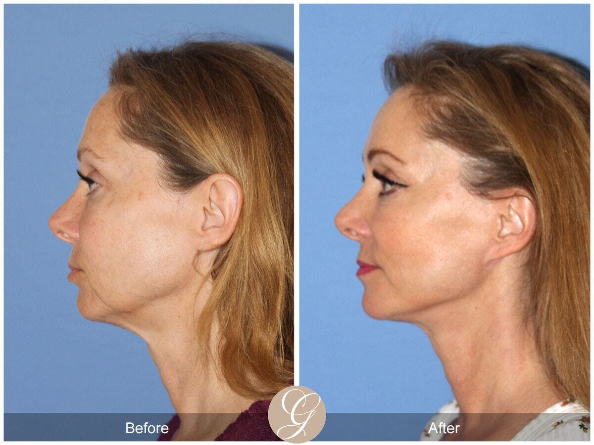 Facelift 50s Before & After Gallery - Patient 978693 - Image 1