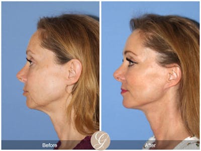 Facelift 50s Before & After Gallery - Patient 978693 - Image 1