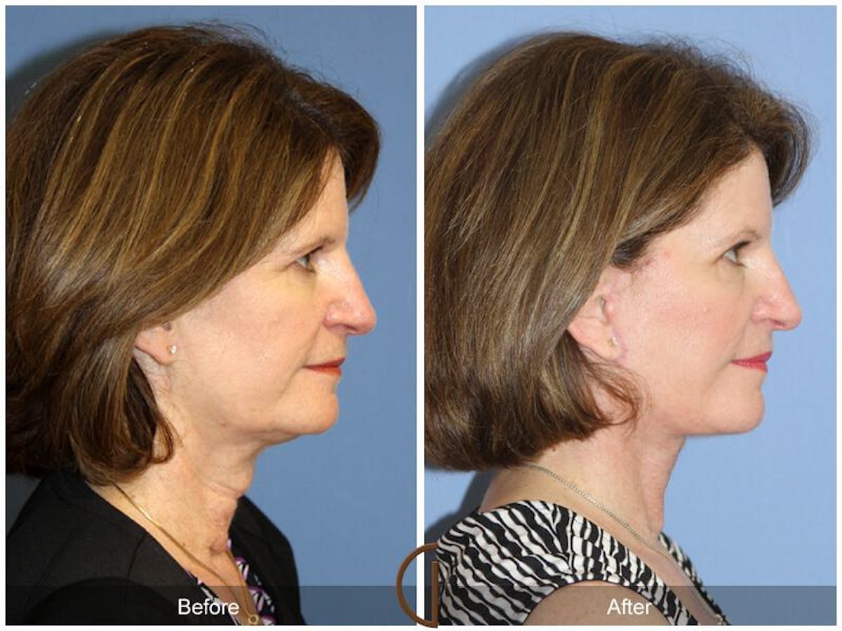 Facelift 50s Before & After Gallery - Patient 388415 - Image 2