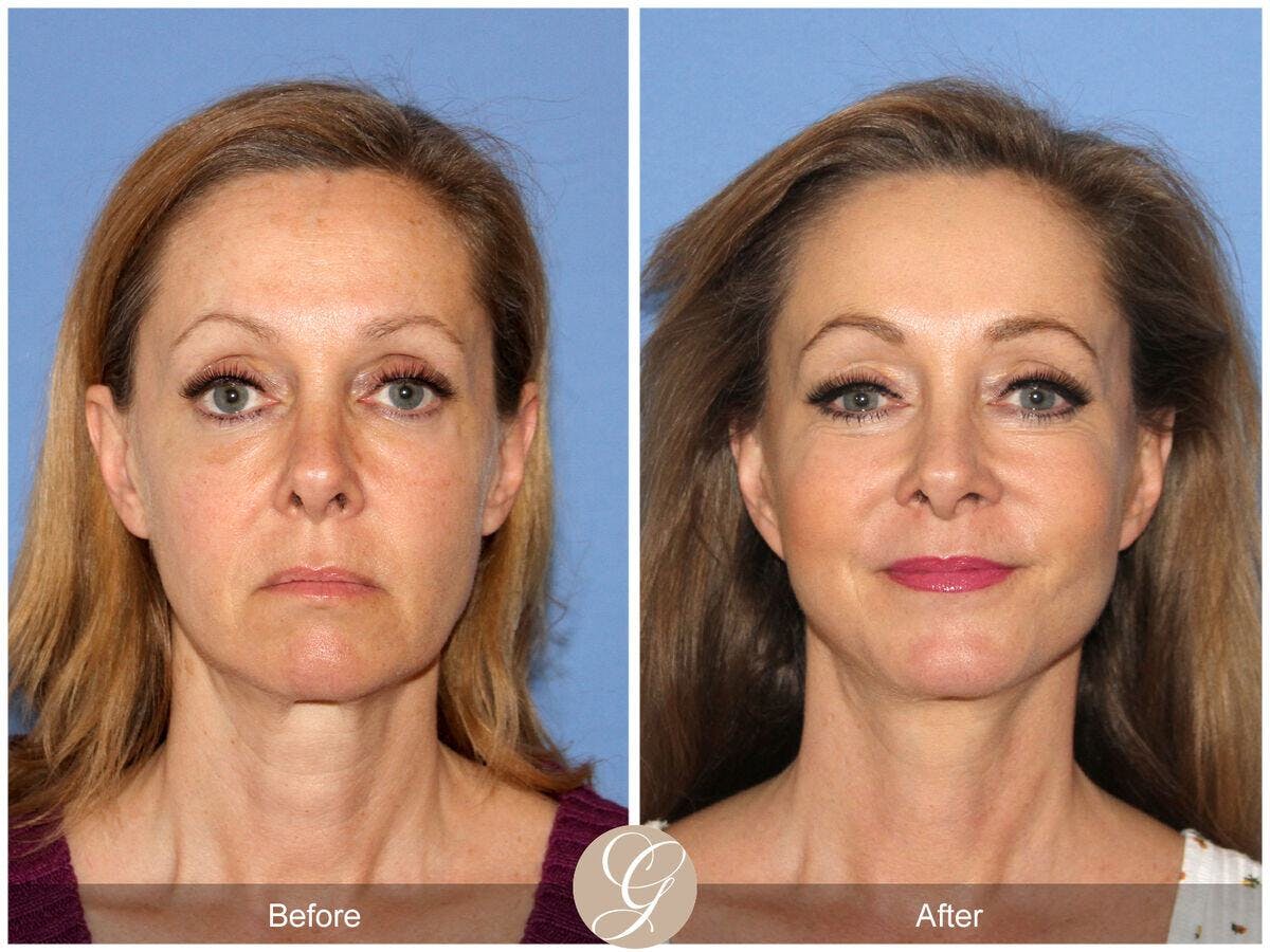 Facelift 50s Before & After Gallery - Patient 978693 - Image 2