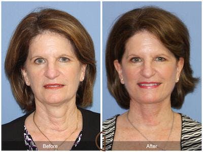 Facelift 50s Before & After Gallery - Patient 388415 - Image 1