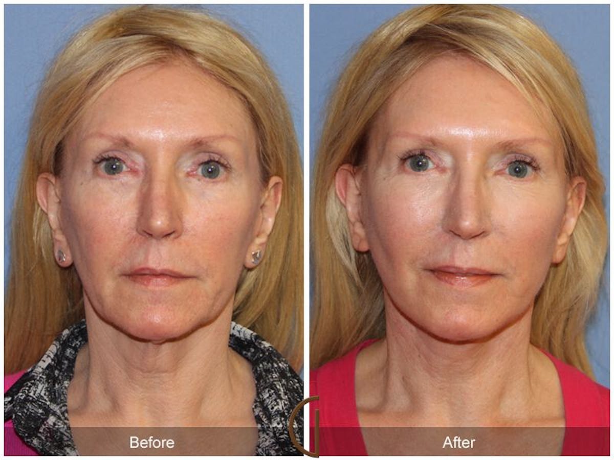Facelift 50s Before & After Gallery - Patient 109259 - Image 2
