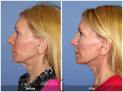 Facelift 50s Before & After Gallery - Patient 109259 - Image 1