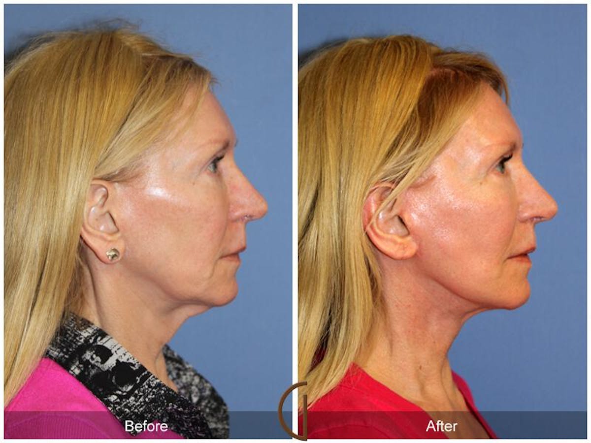 Facelift 50s Before & After Gallery - Patient 109259 - Image 3