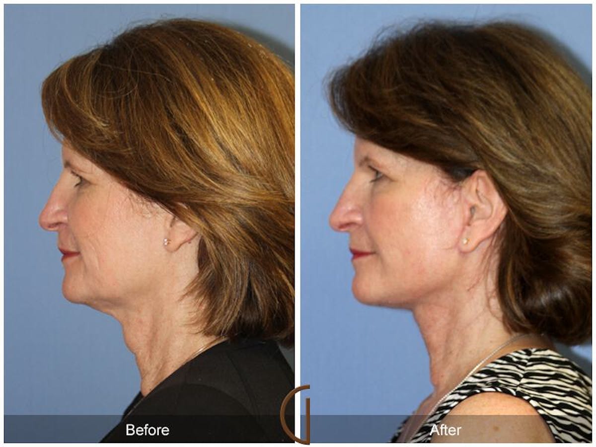 Facelift 50s Before & After Gallery - Patient 388415 - Image 3