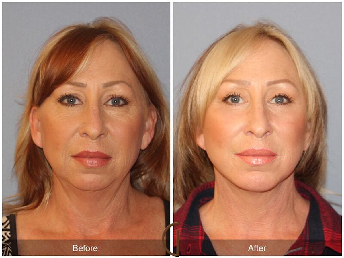Facelift 50s Before & After Gallery - Patient 160031 - Image 2
