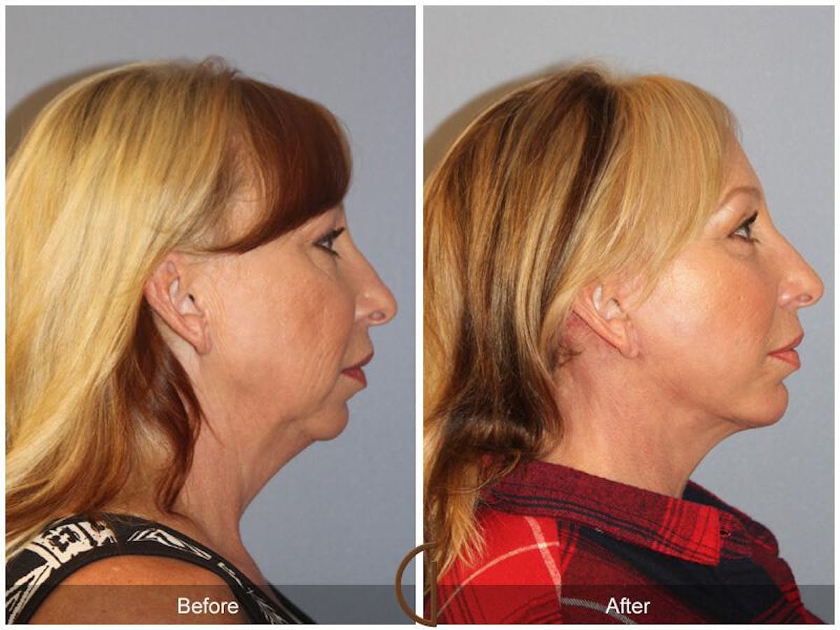 Facelift 50s Before & After Gallery - Patient 160031 - Image 3