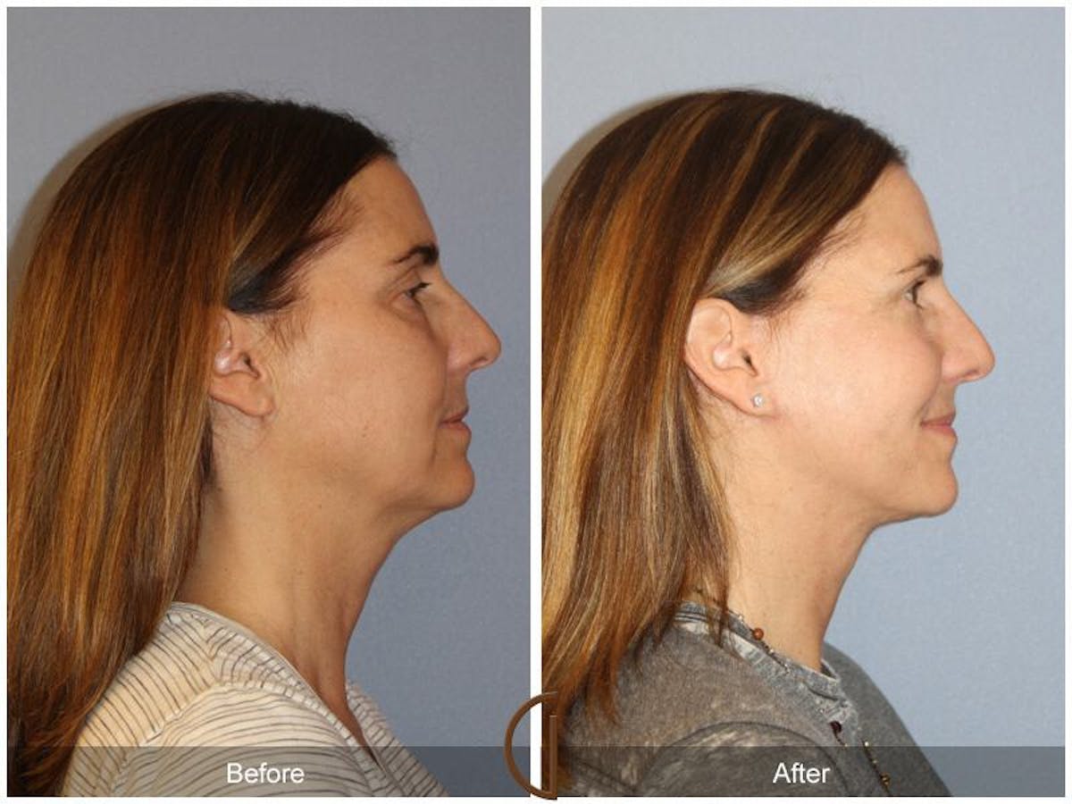Facelift 50s Before & After Gallery - Patient 314008 - Image 3