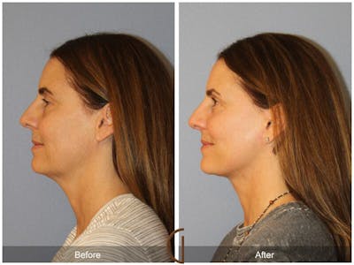 Facelift 50s Before & After Gallery - Patient 314008 - Image 1