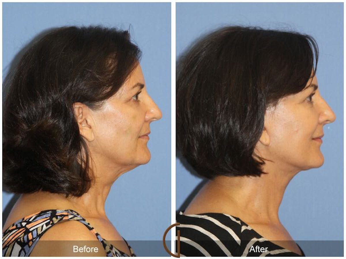 Facelift 50s Before & After Gallery - Patient 188284 - Image 3