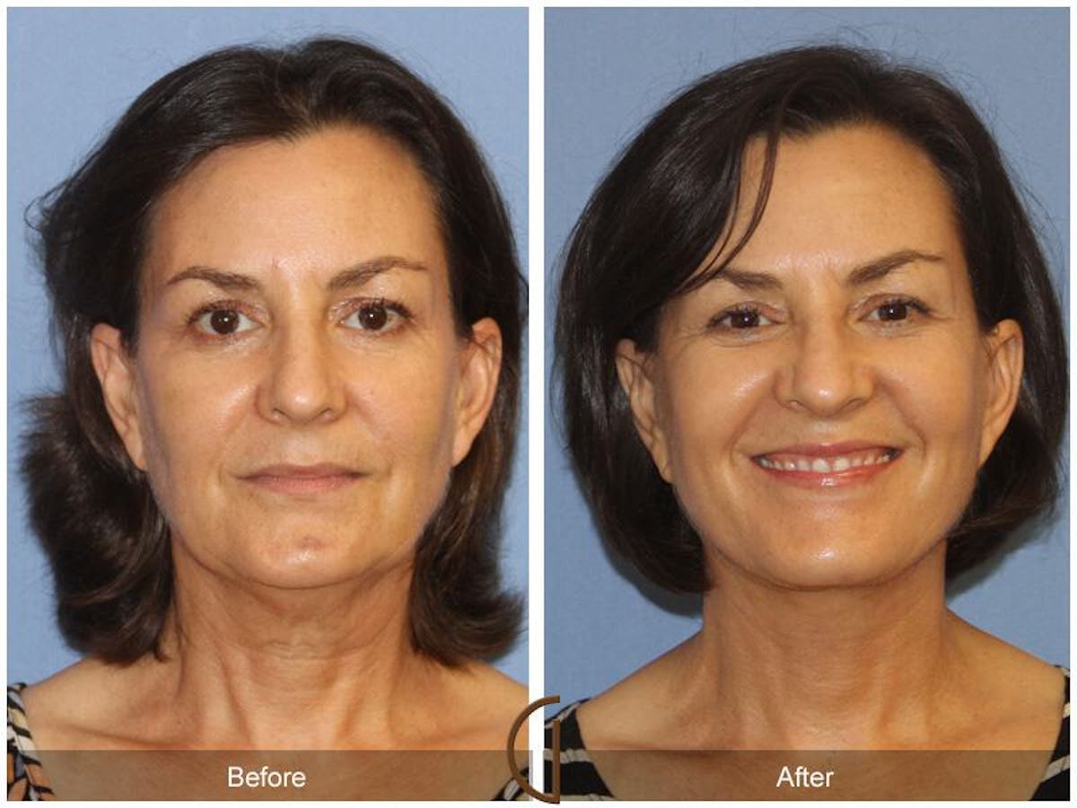 Facelift 50s Before & After Gallery - Patient 188284 - Image 2