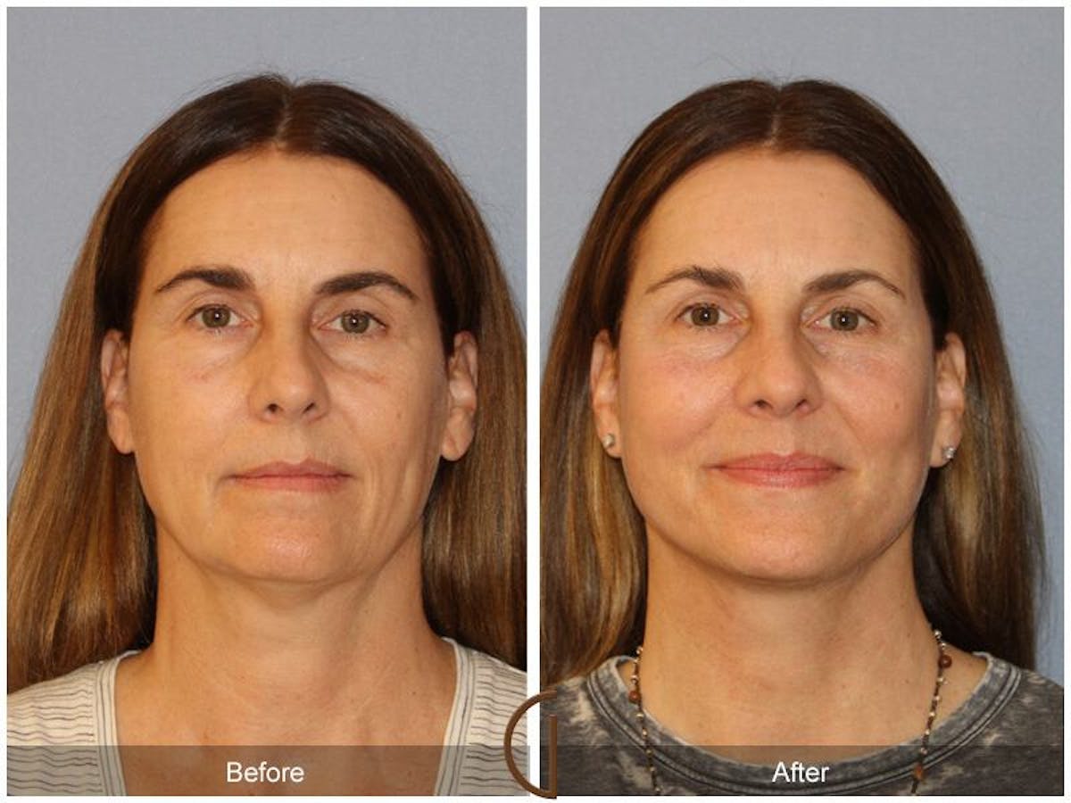 Facelift 50s Before & After Gallery - Patient 314008 - Image 2