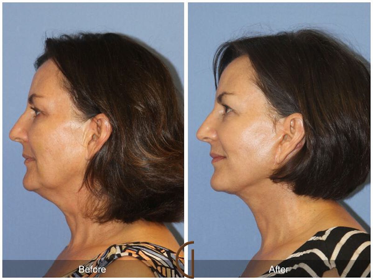 Facelift 50s Before & After Gallery - Patient 188284 - Image 1