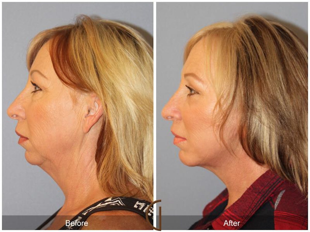 Facelift 50s Before & After Gallery - Patient 160031 - Image 1