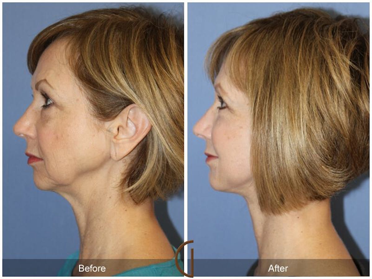 Facelift 50s Before & After Gallery - Patient 240796 - Image 1